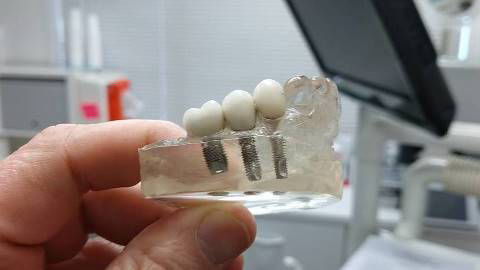 Dental Implants Model