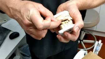 Prosthodontics Restoring With Implant Bridge & Crowns Restores Normal Chewing Function
